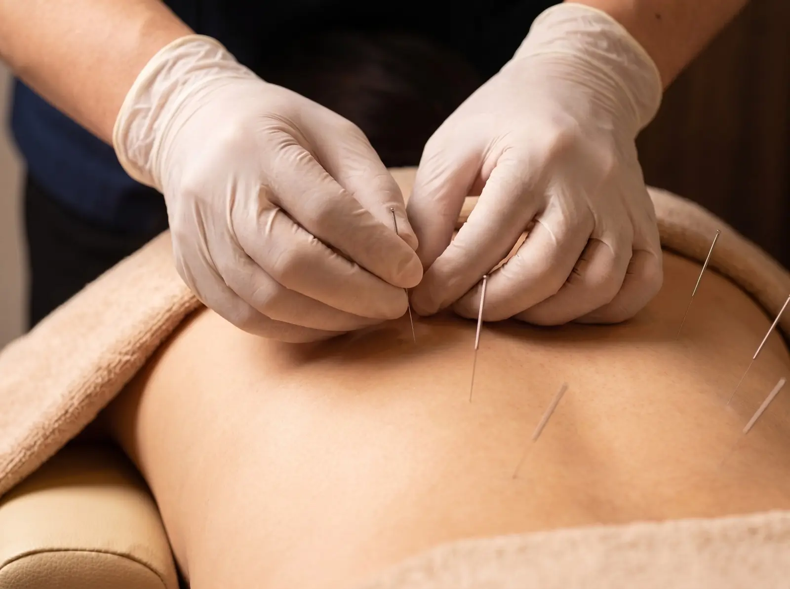 Bali acupuncture therapy